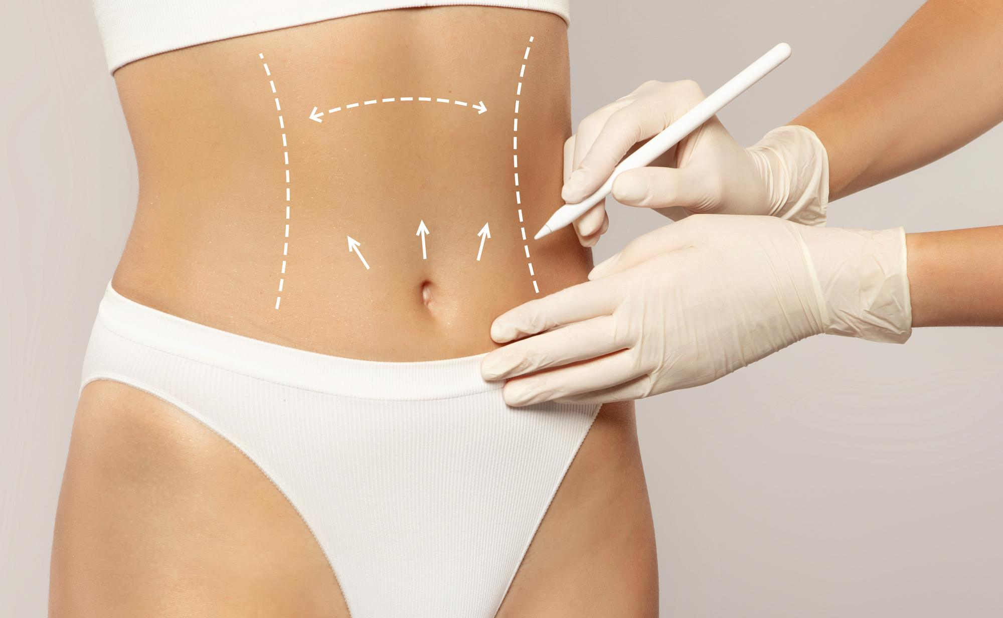 Abdominoplastia