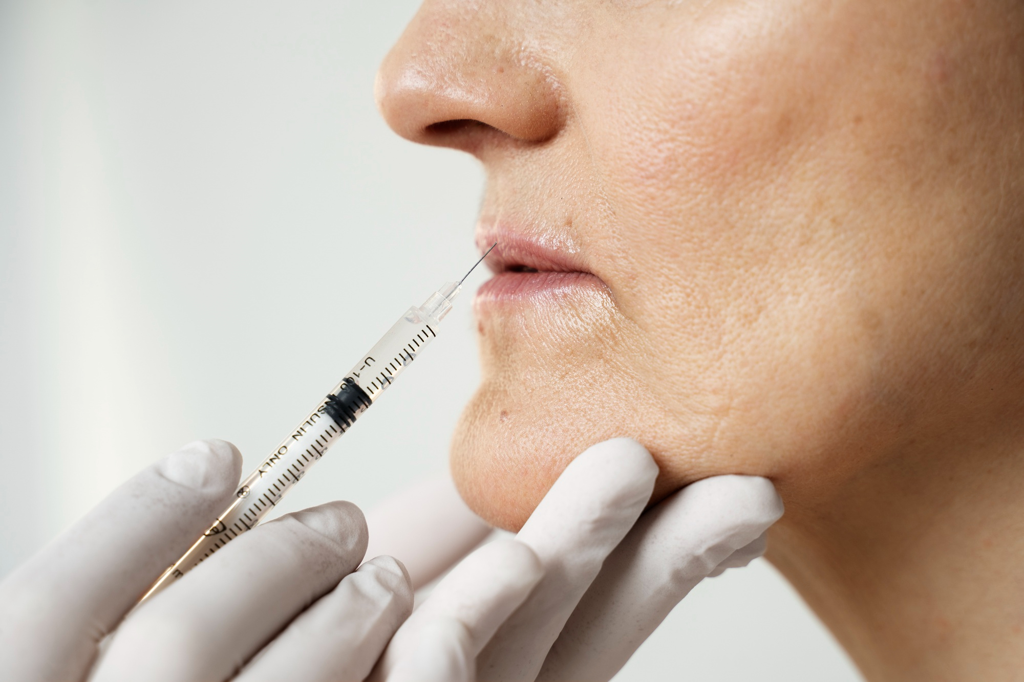 injectare-acid-hialuronic injectare acid hialuronic