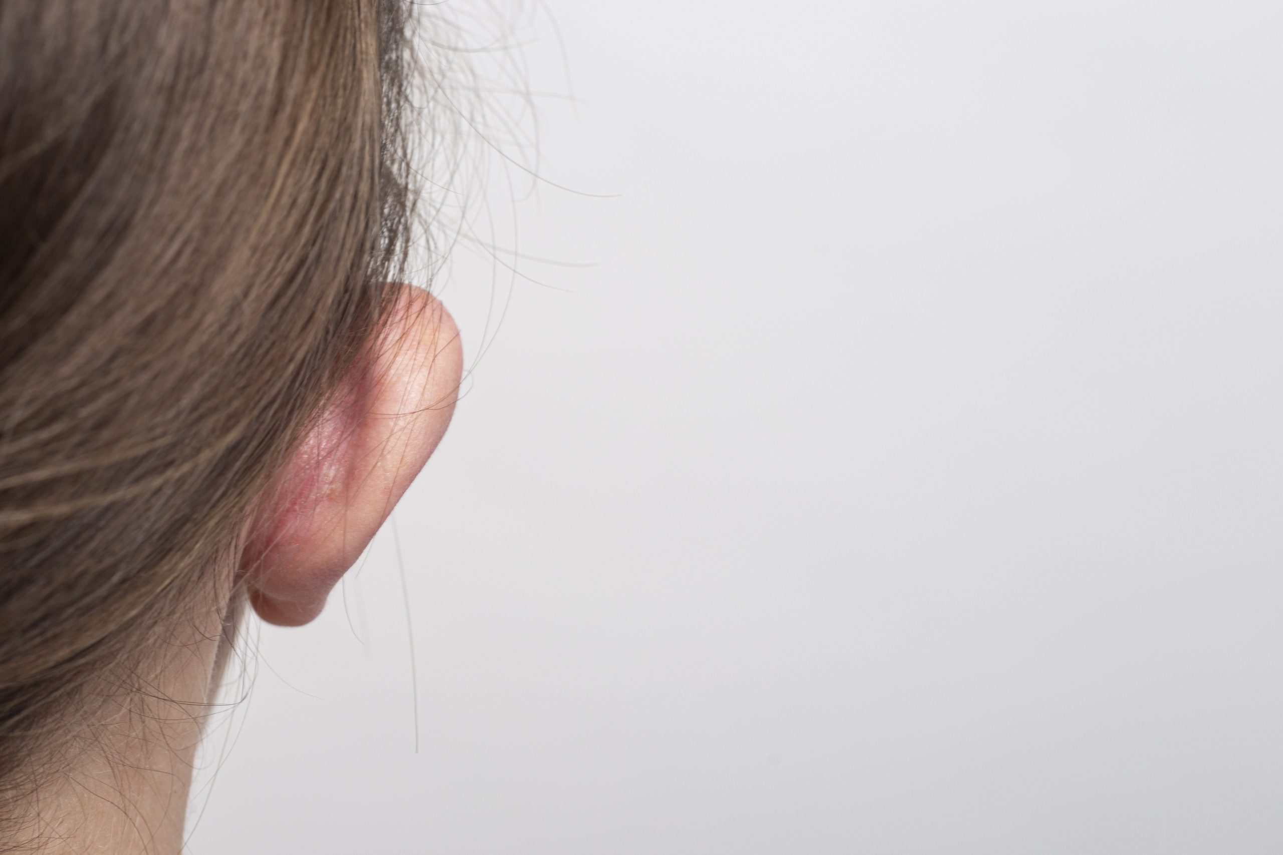 Otoplastie – urechi proeminente